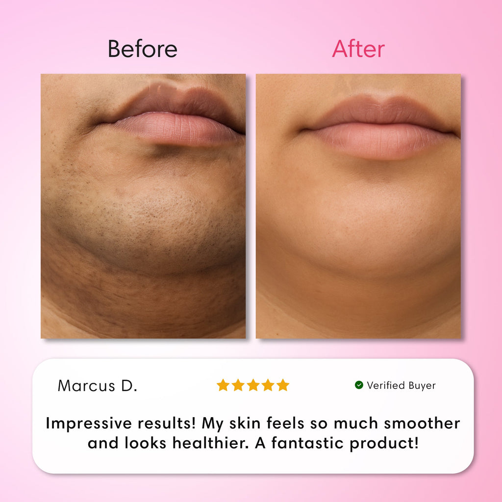 Hair Removal Trilogy Kit